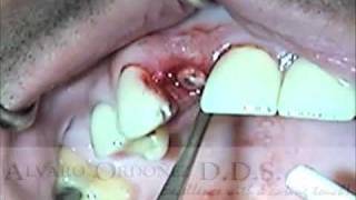 Atraumatic Extraction Socket preservation and temporization  Alvaro Ordoñez DDS [upl. by Tade]