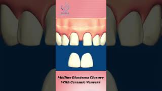 viralshorts Midline diastema closure using veneers [upl. by Tavis825]