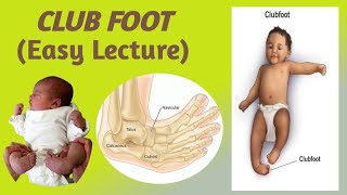 CLUB FOOTTALIPES EQUINOVARUSEpidemiology etiology risk factors classification and Management [upl. by Sedberry943]