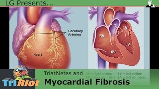 MYOCARDIAL FIBROSIS in Triathletes [upl. by Leuamme]