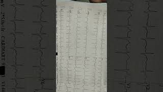 Atrial fibrillation  there is no visible p wave as well as irregular QRS wave [upl. by Helas380]