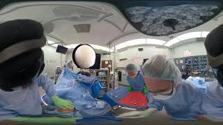 Left Knee Arthroscopy Setup and Loose Body Removal  GoPro Fusion 360 [upl. by Bidle]