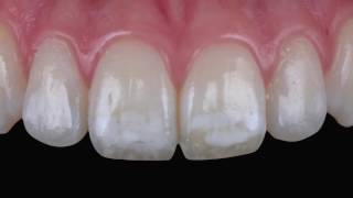 Tratamiento de la fluorosis mediante infiltración ICON [upl. by Orfield490]