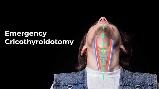 Performing an Emergent Cricothyroidotomy  MEDZCOOL [upl. by Press7]