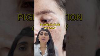 Melasma  Melasma treatment  Pigmentation  Pigmentation on face melasma [upl. by Nahtal]