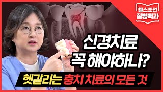 충치 치료 신경치료 꼭 해야하나 헷갈리는 충치 치료의 모든 것 [upl. by Ynitsed]