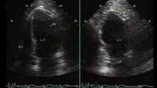 InferiorPosterior and Lateral Myocardial Infarction [upl. by Mclyman]