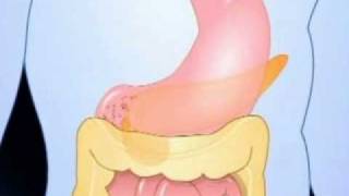 Diabetes Mellitus Type 1 Vs Type 2 التفرقة بين السكري الاول والثاني [upl. by Neahs]