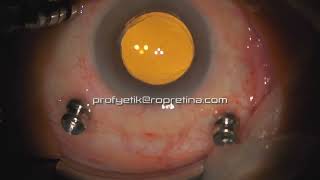 Vitreomacular Traction Vitrectomy Surgery [upl. by Aed]