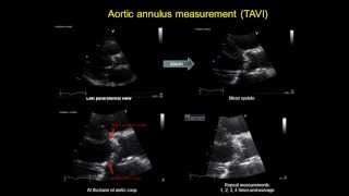 AORTIC ANNULUS MEASUREMENT  TAVI  transcatheter aortic valve implantation [upl. by Jahdai]