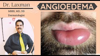 What Is Angioedema  Angioedema  Causes N Treatment  Allergy  Dermatology [upl. by Tillfourd]