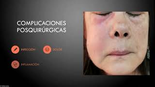 Alveolitis Complicación más frecuente en la tercera molar [upl. by Ecinahc988]