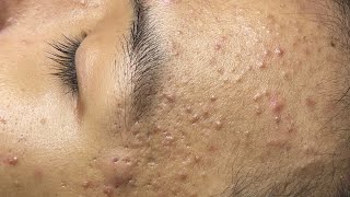 ACNE TREATMENT VU QUYNH MI Acne On Teens Cheek 2024 [upl. by Shivers]