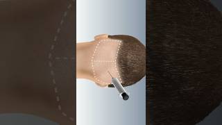 FUE Hair Transplant Have you had any experience with this procedure [upl. by Nirag]