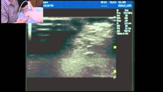 Ultrasound guided ankle block part 2 Supdeep peronealfibular nerves and saphenous nerve [upl. by Anewor773]