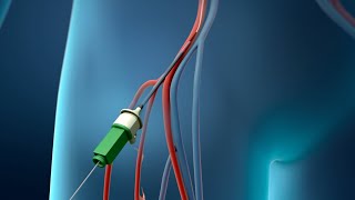 Coronary Angioplasty Femoral Access [upl. by Aneerhs]