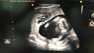 Subchorionic and retroplacental hematoma ultrasound sonography [upl. by Winifred]