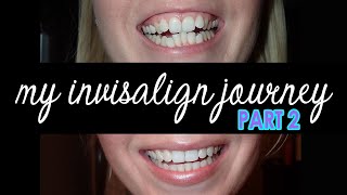 My Invisalign Journey PART 2  Halfway Through Straightening My Teeth With Invisalign Process [upl. by Todd861]