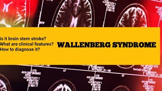 wallenberg syndrome  wallenberg syndrome mnemonic [upl. by Evets]