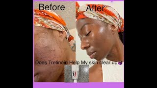 Does Tretinoin Works On Darker Skin Complexion [upl. by Seaver138]