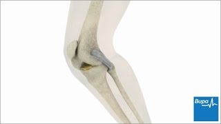 How knee arthroscopy is carried out  Bupa Health [upl. by Abehshtab15]