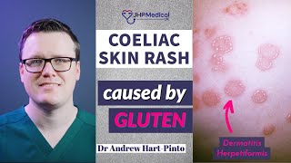 Dermatitis Herpetiformis Skin Rash Linked To Coeliac Disease Celiac And Gluten Intolerance [upl. by Parette]