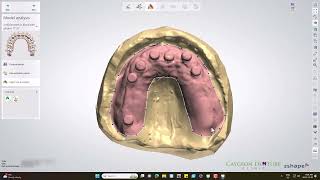 CUD with 7 Locator Abutments [upl. by Aititil]