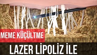 Meme Küçültme Ameliyatı  Lazer Liposuction ile [upl. by Eibob]