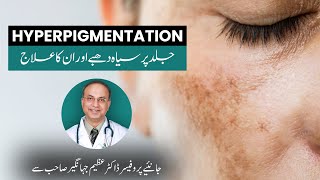 Hyperpigmentation and its treatments explained by Prof Dr Azim Jahangir Khan  Cosmetique [upl. by Toor]