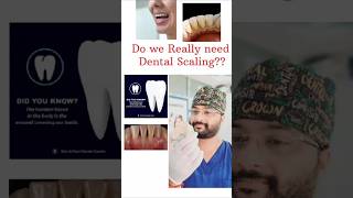 The Ultimate Guide to Dental Teeth Cleaning Everything You Need to Know yt shorts ytshorts [upl. by Einahpit]