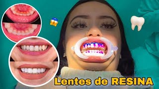 Coloquei FACETAS EM RESINAS nos dentes procedimento valor cuidados [upl. by Eirrotal445]