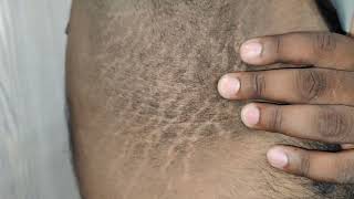 Acanthosis Nigricans [upl. by Georgie]