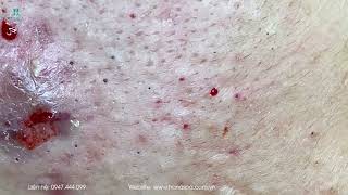 Big Cystic Acne Blackheads Extraction Blackheads amp Milia Whiteheads Removal Pimple Popping [upl. by Leonor]