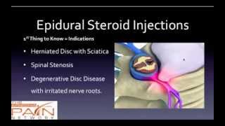 5 Things to Know About Epidural Steroid Injections 602 5076550 [upl. by Attennaj117]