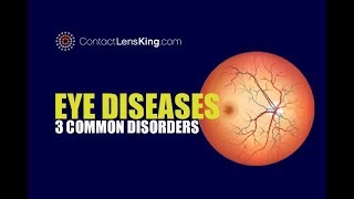 Eye Diseases  3 Common Eye Conditions [upl. by Joelly]