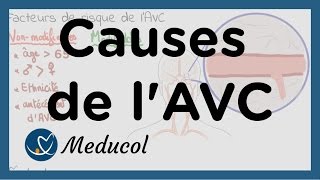 AVC causes  AVC facteurs de risque [upl. by Poppas]