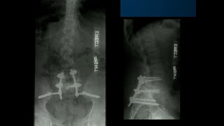 The Role of Reduction in Dysplastic Spondylolisthesis  Sigurd Berven MD [upl. by Tenom]