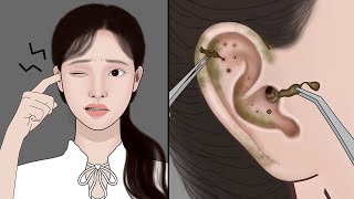 ASMR Ear Stone Removal Digging Out Super Big Earwax  ASMR Animation  Mengs Stop Motiom [upl. by Pimbley]