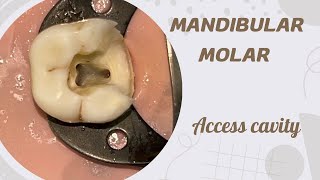 Access opening of Mandibular Molar [upl. by Coral]