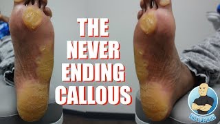 EXTREME UNBELIEVABLE NEVER ENDING THICKEST FOOT CALLUSCALLOUS REMOVAL [upl. by Kopaz]