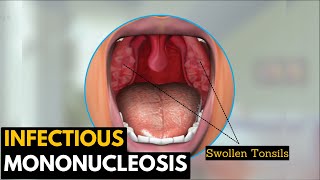 Infectious mononucleosis Causes Signs and Symptoms Diagnosis and Treatment [upl. by Dobb]