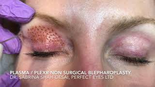 Nanoplasma or Plexr blepharoplasty [upl. by Richman594]