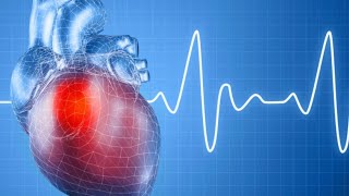 J’ai encore des extrasystoles après une ablation de tachycardie  échec de l’ablation [upl. by Gisella]