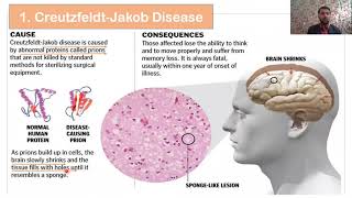 Types of Prions Diseases  Prions diseases in Animals and Human  Part 02 [upl. by Meridel915]