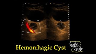 Adnexal Hemorrhagic Cyst  Ultrasound  Case 33 [upl. by Elleinod]