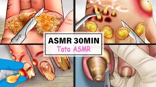 ASMR Relax Collection Ingrown Toenail Removal Ingrown Nails Perennial Toenail Pus [upl. by Hedgcock659]