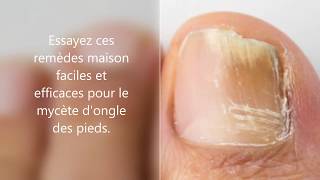 Comment jai soigné ma mycose des pieds facilement et naturellement  Allez Santé [upl. by Riamu]