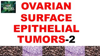 OVARIAN TUMORS  Part 3  ENDOMETRIOID CLEAR CELL amp BRENNER TUMOR Pathology [upl. by Aicele]