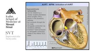 Supra Ventricular Tachycardia [upl. by Geoff]