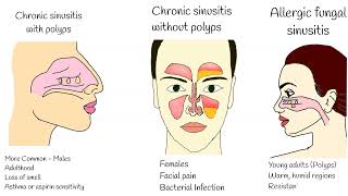 Chronic Sinusitis  Symptoms causes and treatment Sinusitis with polyps Fungal sinusitis [upl. by Dugas41]